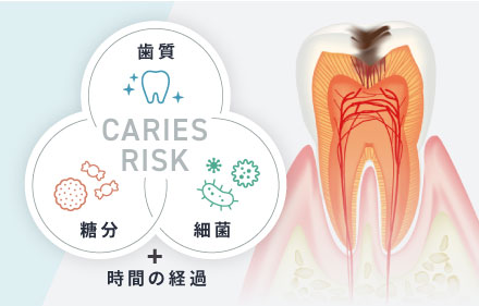 虫歯の原因